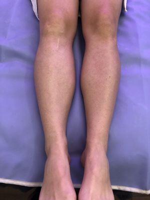 Leg sugaring