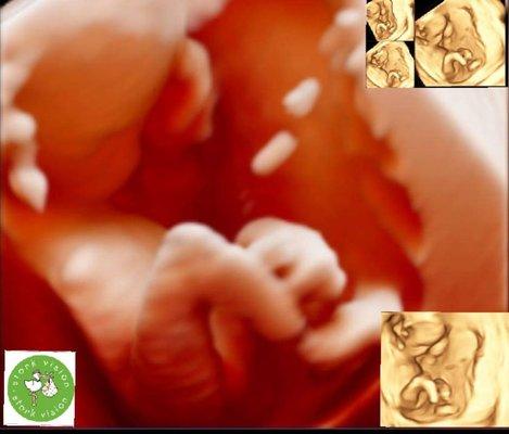 20 Week Ultrasound 3D4D&HD