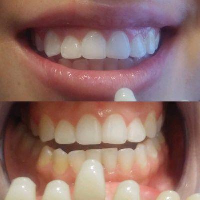 1hour Teeth Whitening  Non sensitivity  Up to five shades lighter