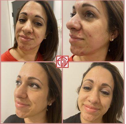 Microneedling before and after