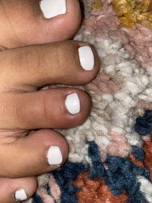 Mild toenail infection of middle digit