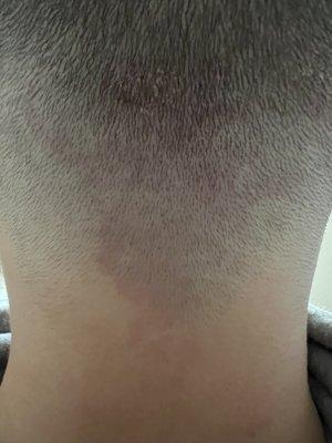 The back of my head after a week.