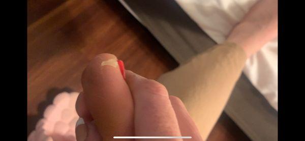 Skin left on big toe