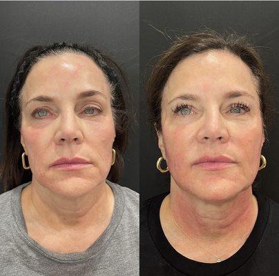 RF Microneedling (3 sessions, 4-6 weeks apart)
Pixel, resurfacing treatment  (2 sessions) 
Sculptra (2 vials) in the lateral face