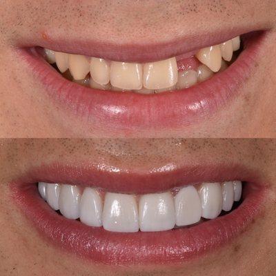 Upper and Lower Porcelain Veneers plus Bridge