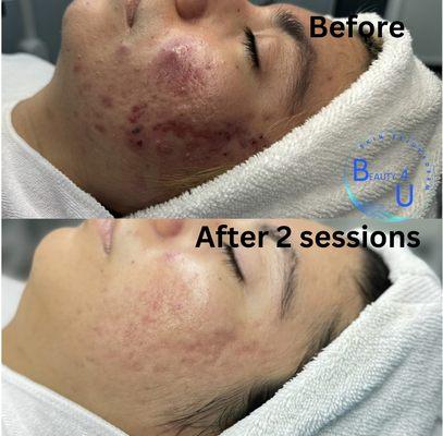 Acne treatment and results. Inquire for recommendation.