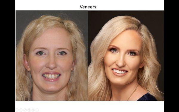 PORCELAIN VENEERS  Dr. Jill Morris Smile makeover before and after