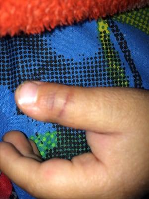 My sons purple broken thumb he got while at this preschool and no staff notified me until I asked about it