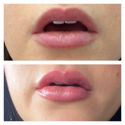 Before and after lip filler, don't mind my crooked lip liner. 1 syringe of juvederm