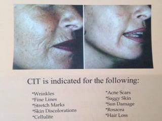 Specializing in Collagen Induction Therapy
                               &
              Customized Skin Care