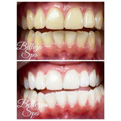 Laser Teeth Whitening in san antonio