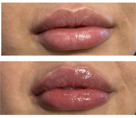 Before & After Lip Filler (half syringe)