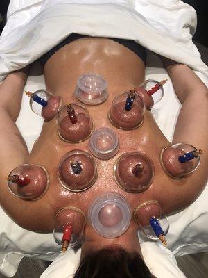 Cupping therapy