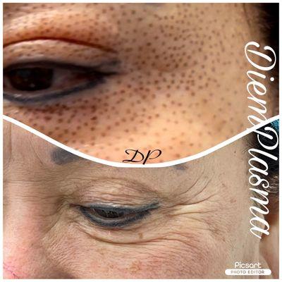 Fibroblast Skin-tightening, Crow feet reduce, make eyeliner form