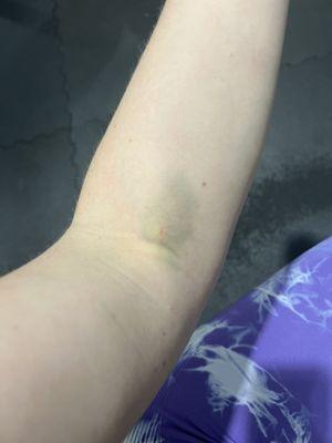 Five days after blood draw