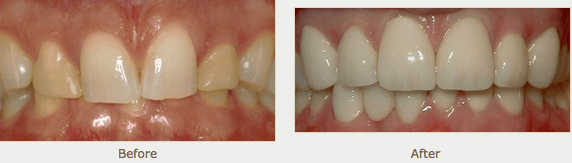 Porcelain Crowns (Caps)