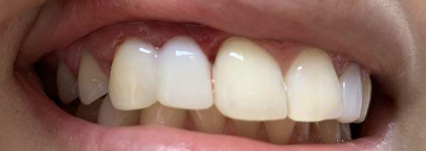 Before and after, all teeth were done with VENEER AND CROWN with LASER GINGIVECTOMY in one visit of three hours in one day.