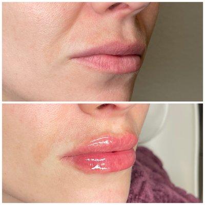 1mL lip enhancement