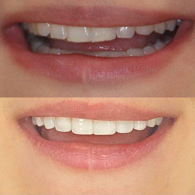 Before on top after on bottom- bioclear veneers