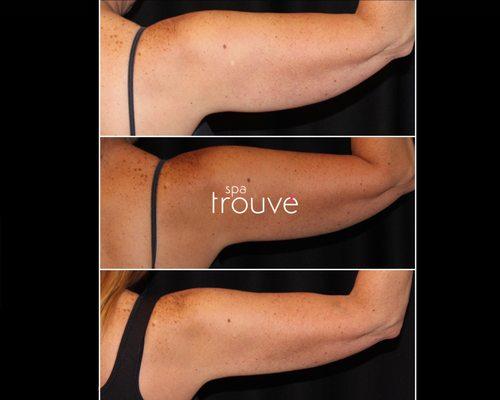 Before & After Photo of CoolSculpting on Arms in Utah