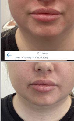 Chin liposuction