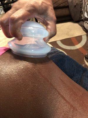 Cupping to help reduce cellulite