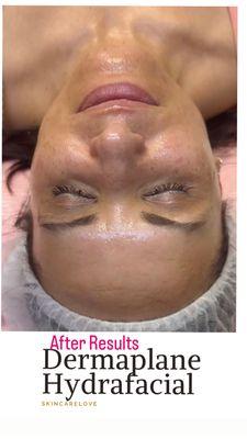 Hydrafacial and Dermaplane