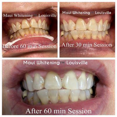 Maui Whitening Louisville