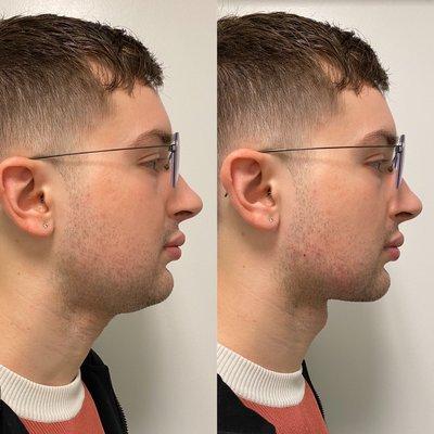 Jawline contouring with PDO Threads. 
PDO Thread Lift