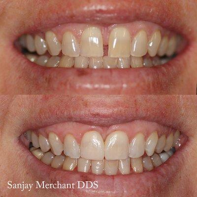 This patient was unhappy with the spacing between her front two teeth and the space was repaired using dental bonding in 1 hour.