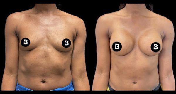 Breast aug #plasticsurgery #buffalo #drdawli