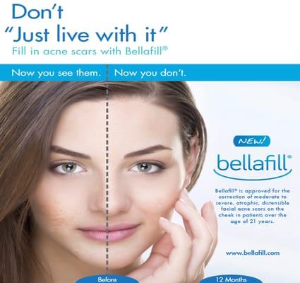 I personal had the Bellafill done at Eden Medical Spa and there was no down time. I left looking younger and feeling good about doing it.