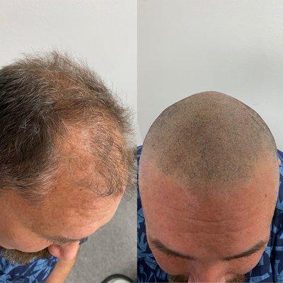 Scalp Micropigmentation Therapy!