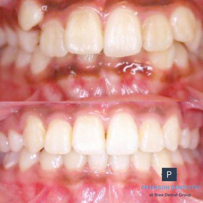 Before and after
 Orthodontic Case