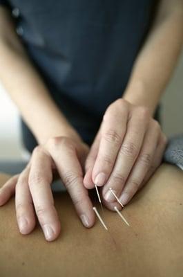 Acupuncture Treatment