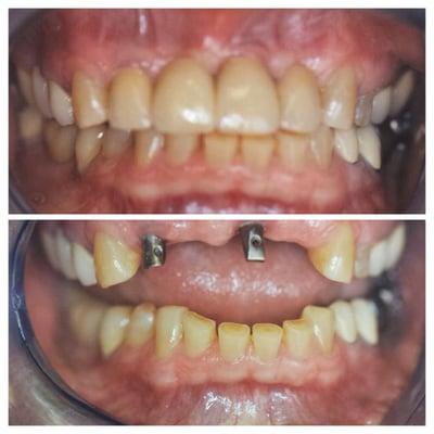 Replacement Of Missing Teeth With Implants