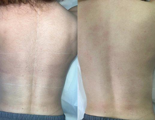 Before/Right after the laser hair removal treatment