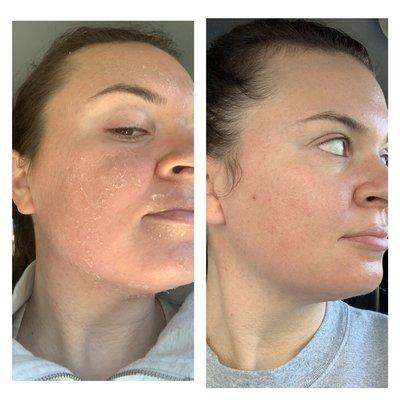 Significant ClearPeel + PigmentLift (jessner peel)