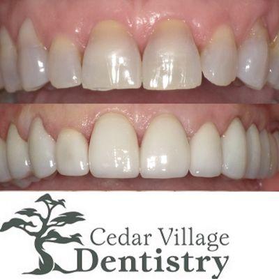 Smile Transformation Before and After- Dr. Thomas Dooley Cedar Village Dentistry