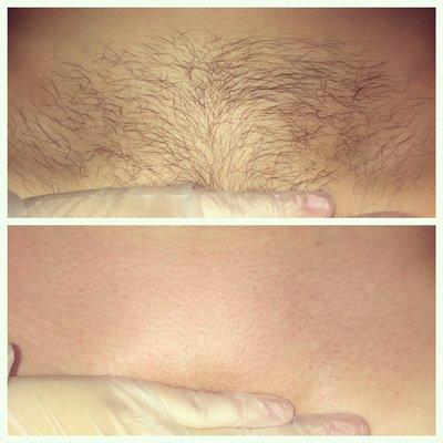 Clients waxing results