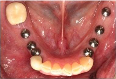 Posterior Implants Placement