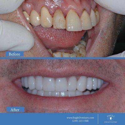 Before & After Smile Makeover