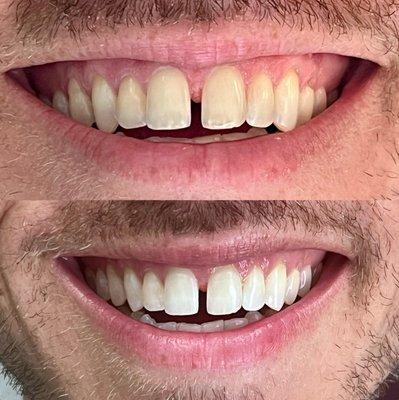 Check out our in-office results with KoR Whitening!