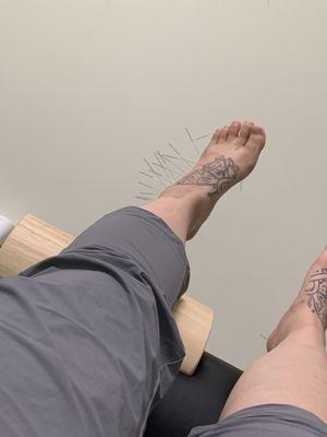 Treating ankle sprain