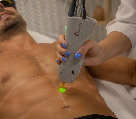 Laser Hair Removal