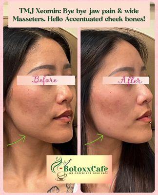 TMJ Masseter slimming, Jaw pain gone, naturally displaying her hidden cheek bones.