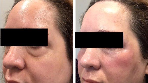 Tear Trough correction and cheek augmentation in 43 year old woman using Radiesse and Belotero Fillers