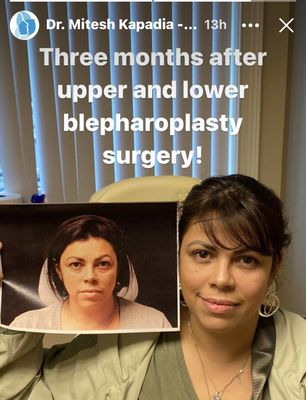 I had both upper and lower done by Dr Kapadia.  If you have been looking for the best, look no further! I wish I had done it sooner.