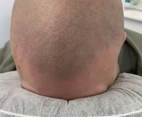 Scalp micro pigmentation