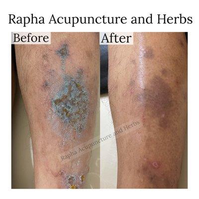 Severe Eczema treatment on the leg